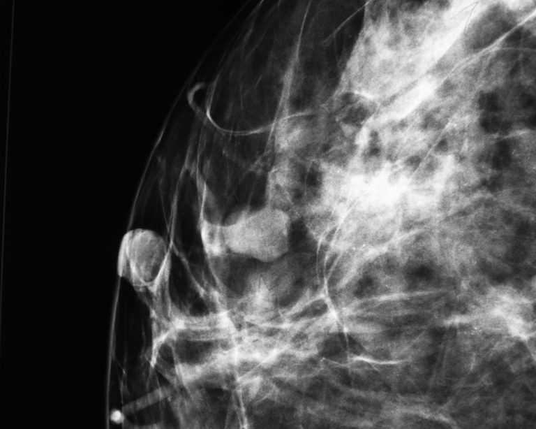 Matemáticos de la UAA diseñan software contra el cáncer